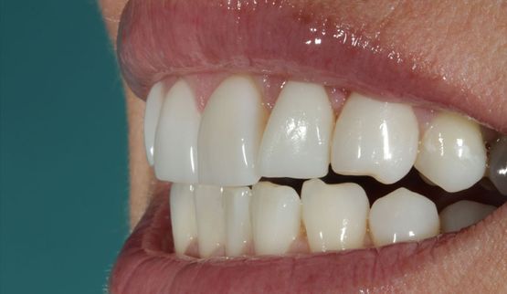 Veneer-nachher Seitenansicht