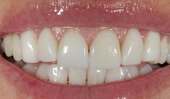 Veneers-nachher