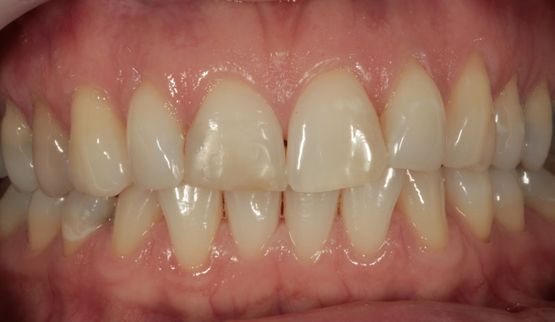 Veneers-vorher