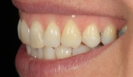 Veneer-vorher Seitenansicht